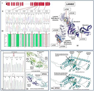 Screening of the LAMB2, WT1, NPHS1, and NPHS2 Genes in Pediatric Nephrotic Syndrome